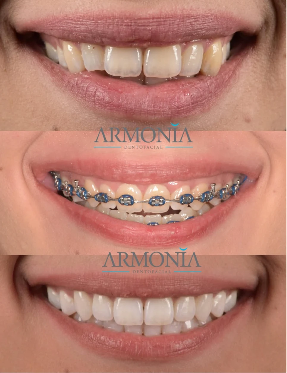 Caso clínico de ortodoncia y estética dental