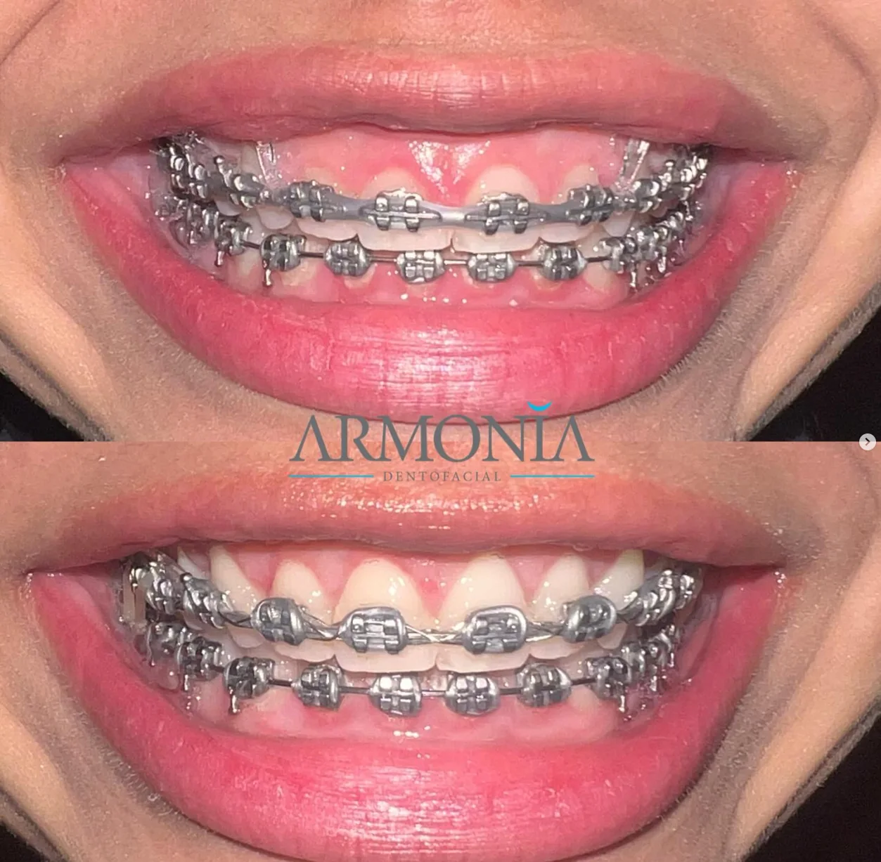 Brackets · Evolución frontal