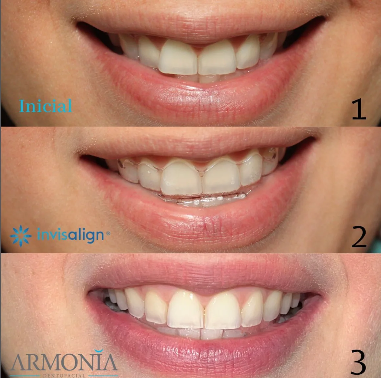 Caso Invisalign