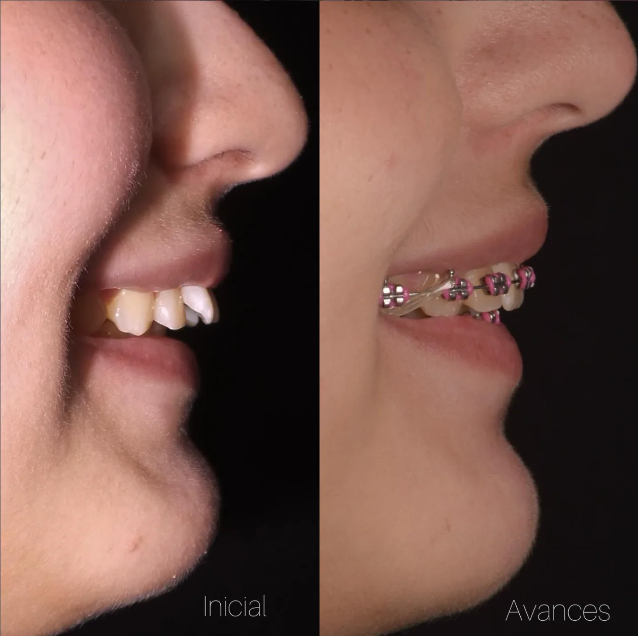 Caso perfil dentofacial