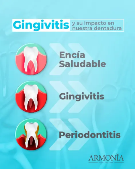 Gingivitis