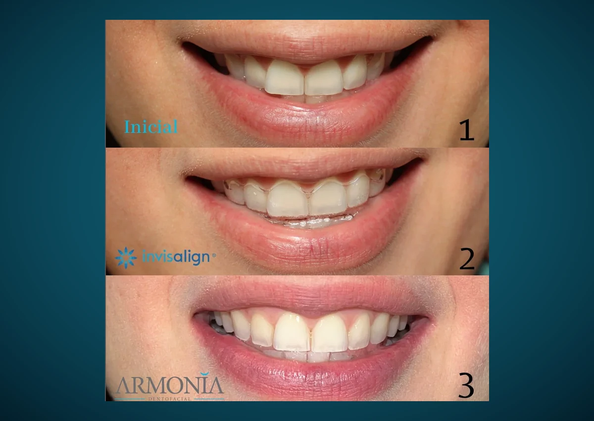 Caso Invisalign Armonía Dentofacial