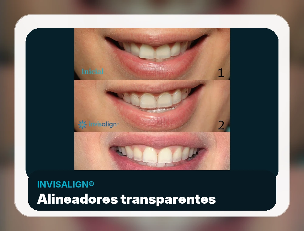 Ortodoncia invisible